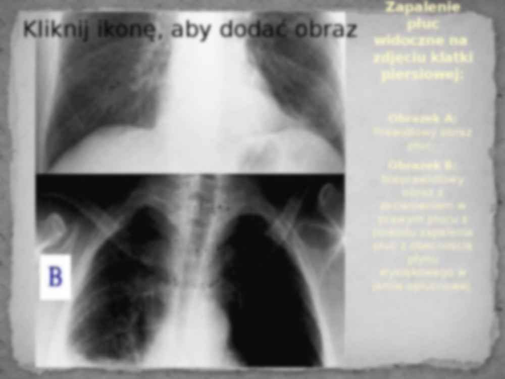 Zapalenie płuc - prezentacja - strona 3